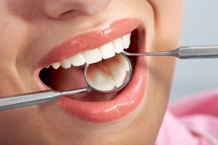 Fisher Pointe   Blog Dental Filling Procedure Steps